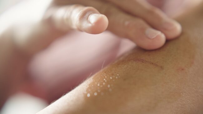 Applying medical gel on skin.